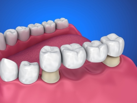 Illustrated dental bridge being fitted over two teeth