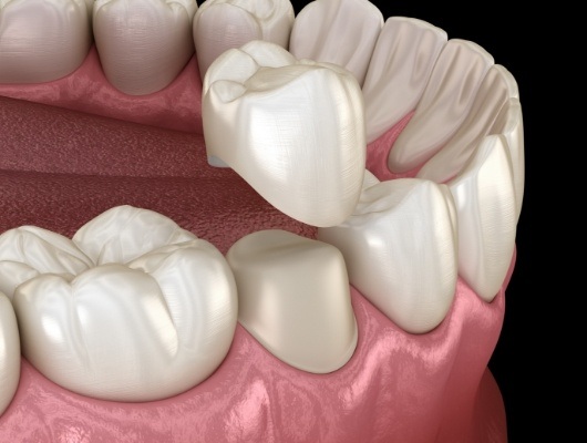 Illustrated dental crown being fitted over a tooth