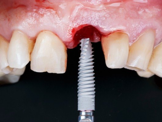 Close up of dental implant being placed in the upper jaw