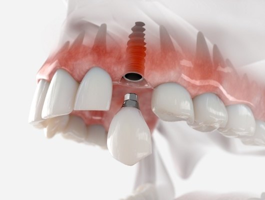 Illustrated dental crown being placed onto dental implant in upper jaw