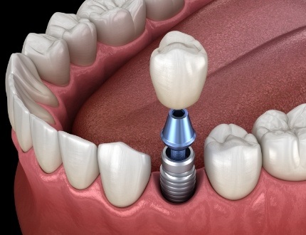 Illustrated dental crown being placed onto a dental implant