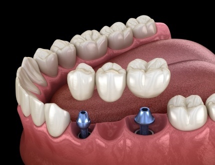 Illustrated dental bridge being placed onto two dental implants