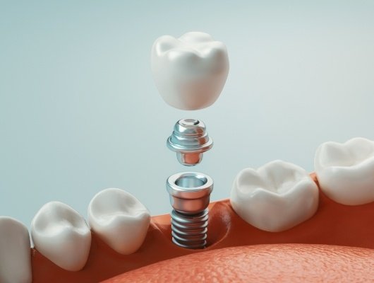 Illustrated dental implant with abutment and crown being placed in lower jaw