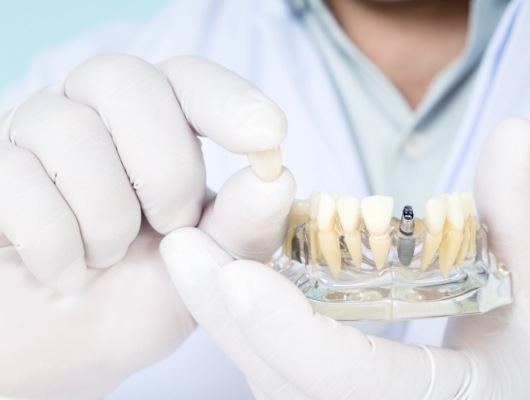 Dentist holding dental crown in one hand and model of mouth with dental implant in the other