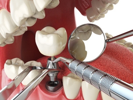 Illustrated dental implant being placed