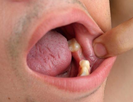 Close up of person with a missing tooth