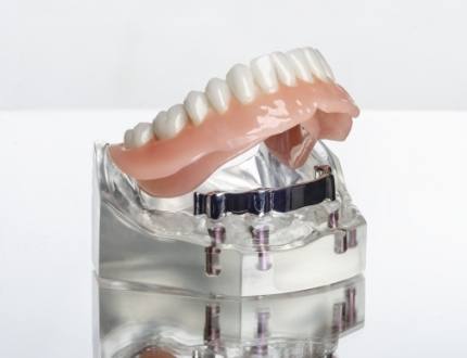 Model of implant denture