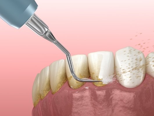 Illustrated dental instrument cleaning plaque buildup from teeth