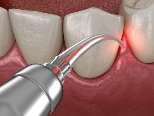 Illustrated soft tissue laser treating gum disease