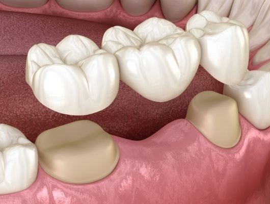 Illustrated dental bridge being fitted to replace a missing tooth