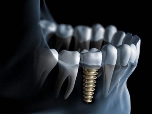 Illustrated X ray of a person with a dental implant in their lower jaw
