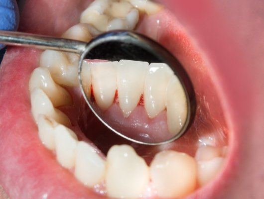 Close up of dental mirror inside of mouth