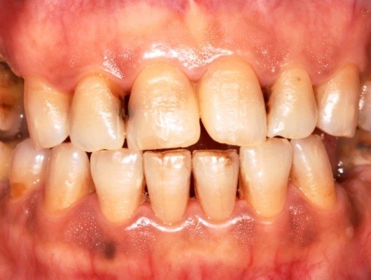 Close up of discolored teeth and receiding gums