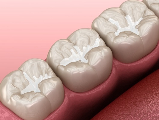 Close up of illustrated row of teeth with dental sealants