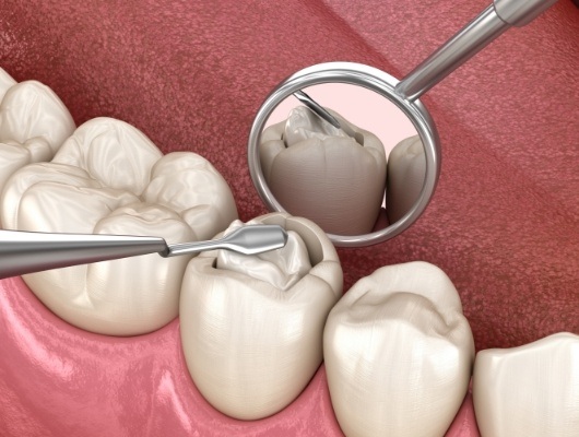 Illustrated diagram of tooth colored filling being placed inside of tooth