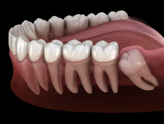 Illustrated impacted wisdom tooth pushing against back molar