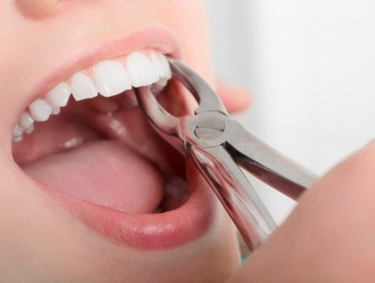 Dentist grasping tooth of a patient with dental forceps