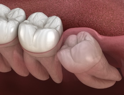 Close up of illustrated impacted wisdom tooth