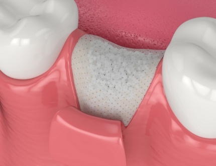 Illustrated bone grafting material being placed at tooth extraction site