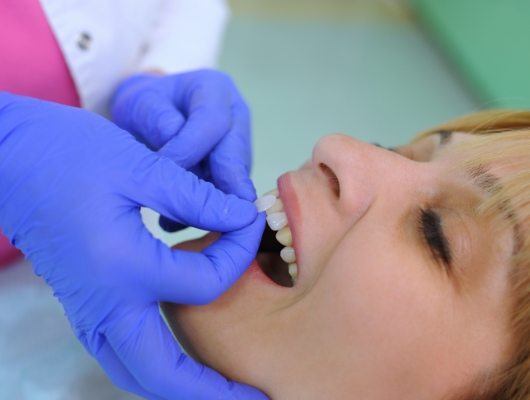Cosmetic dentist placing a veneer on a front tooth