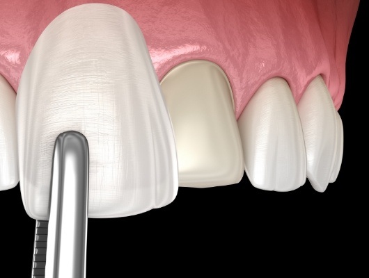 Illustrated veneer being placed over a front tooth