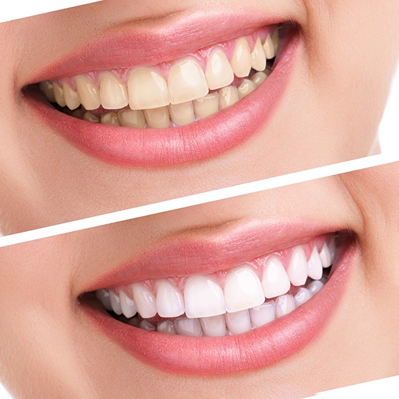 Close up of woman’s teeth before and after whitening treatment