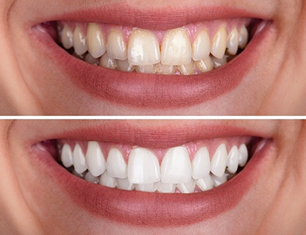 Before and after of teeth whitening treatment