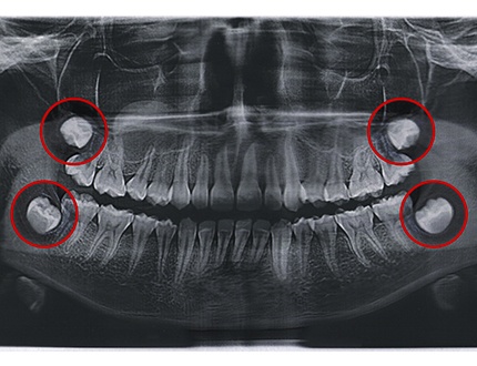 A dental X-ray that highlights a patient’s wisdom teeth