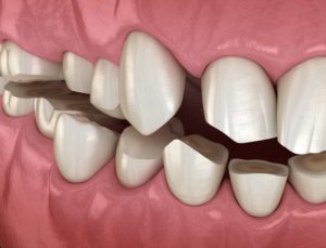 a computer illustration showing worn-down teeth due to bruxism