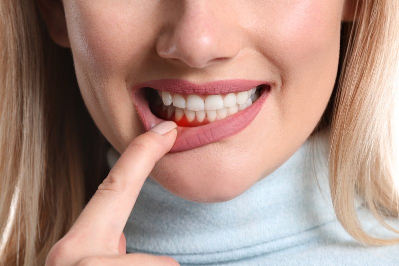 Woman pulling down lower lip to show signs of gum disease