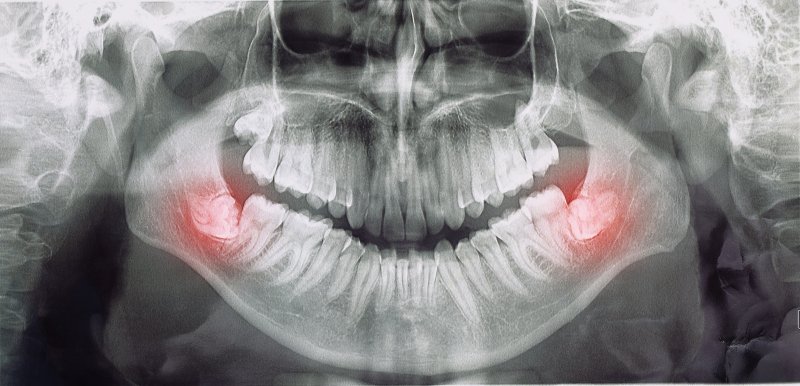 X-ray of a person’s wisdom teeth