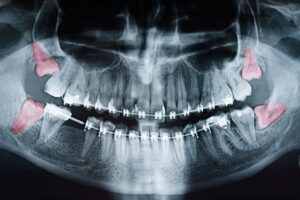 X-ray with wisdom teeth highlighted. 